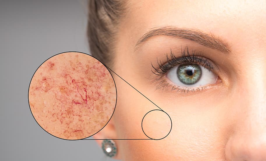 Vascular Laser
