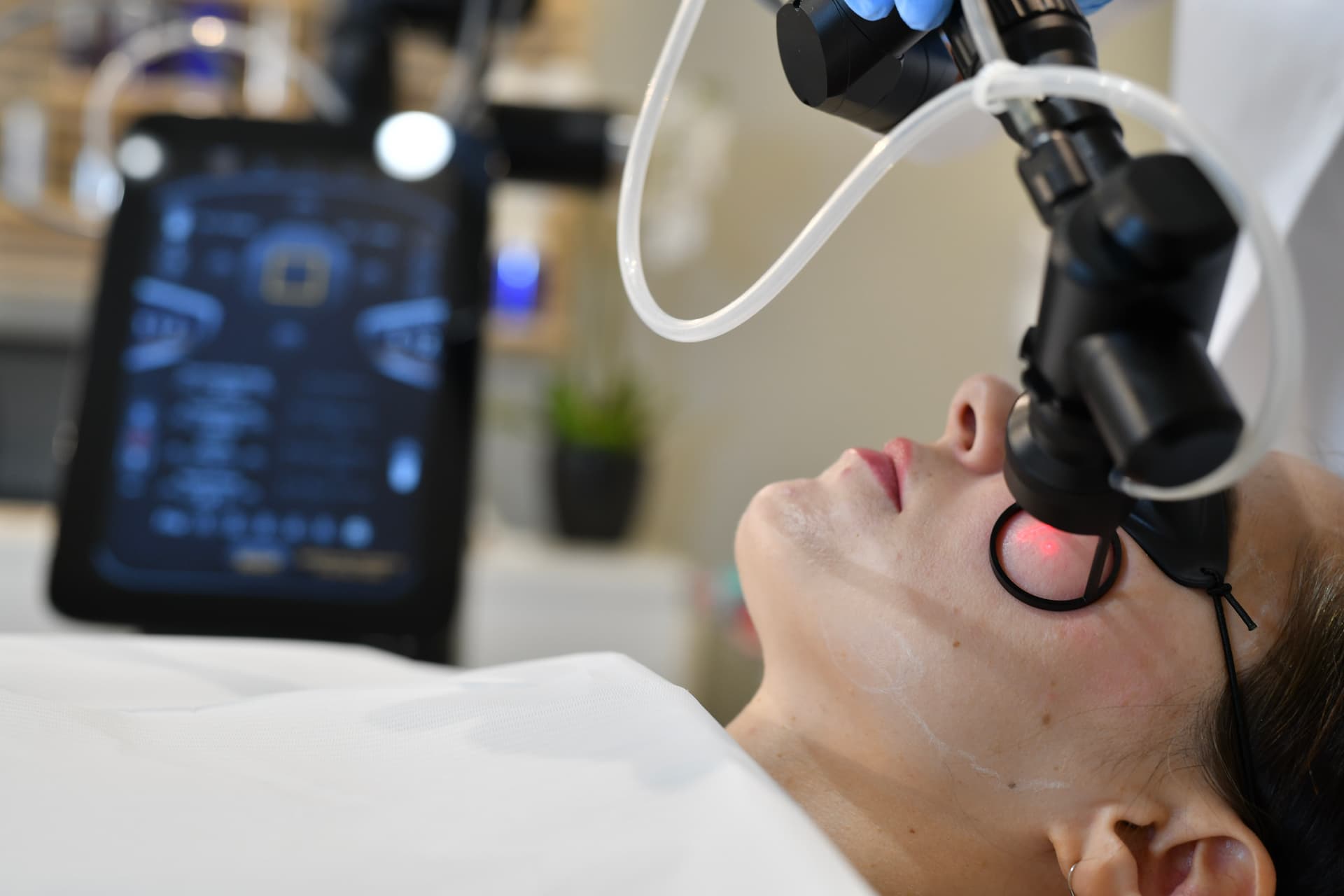 Nedetid etter CO2-laser – dag for dag