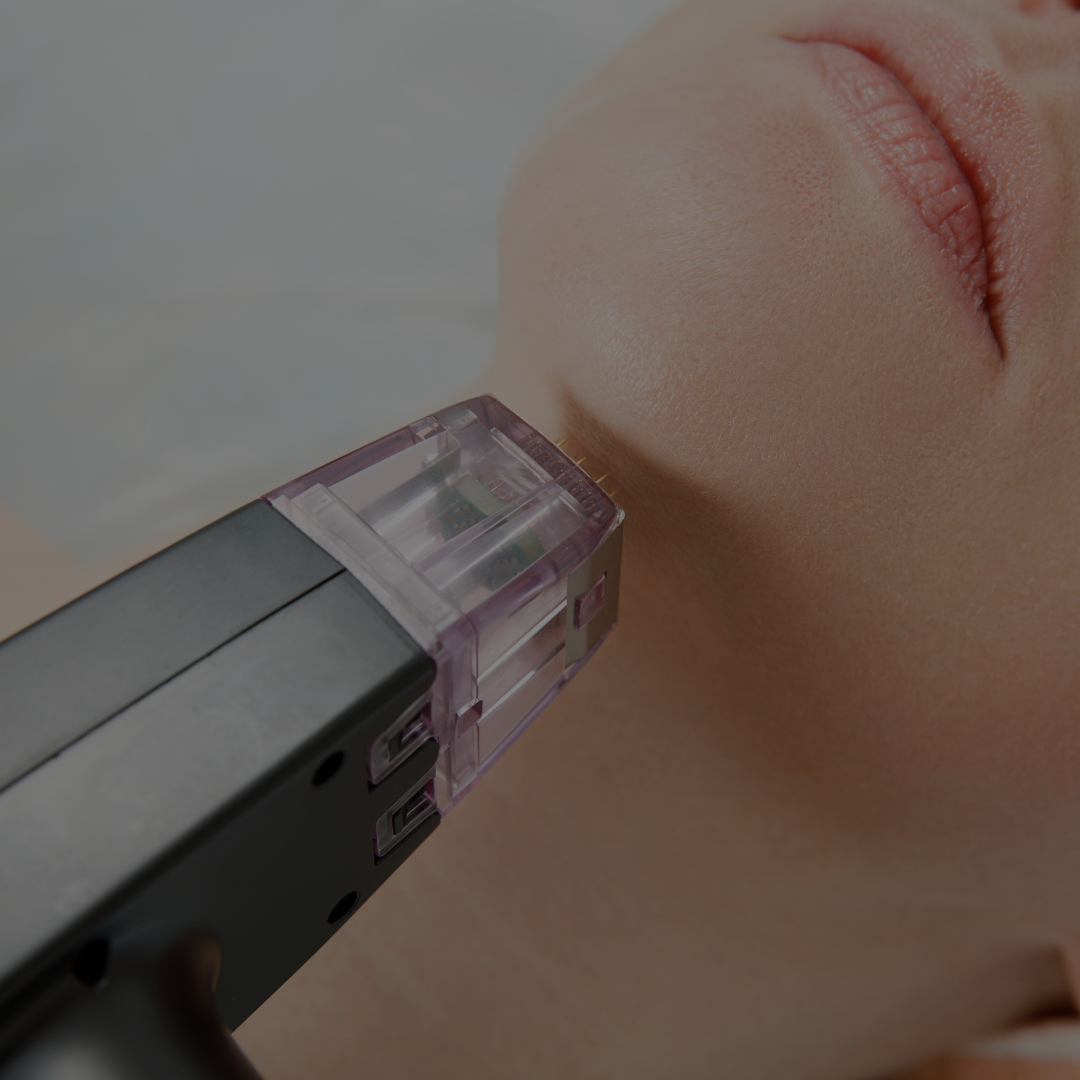RF Microneedling